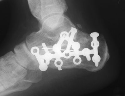 Synthes Calcaneal Plate (Implant 278)
